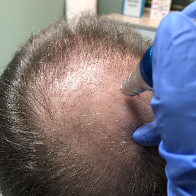 Hair Restoration